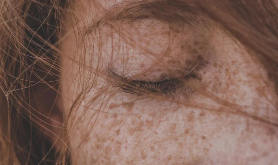 Sucha skóra na pośladkach – jak leczyć?